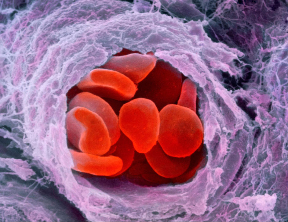 Hemofilia y terapia génica